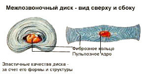 Межпозвонковая грыжа. Межпозвонковый диск